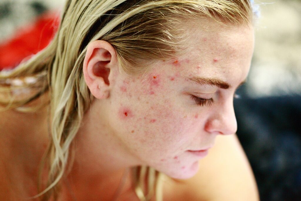 Cystic Acne: Causes, Symptoms, and Treatments